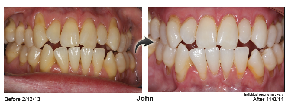 Atlanta gum recession