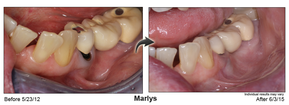 alternative gum grafting Atlanta