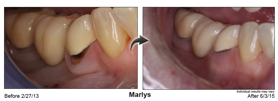 fix receding gums Atlanta